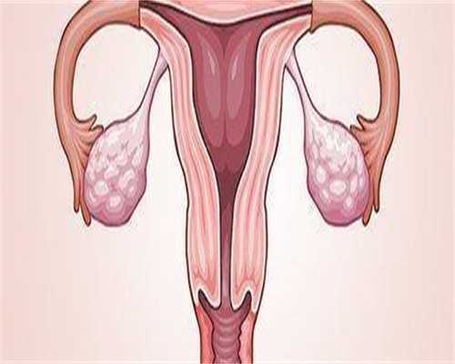 卵巢巧克力囊肿会痛吗！巧克力卵巢囊肿痛严重吗！