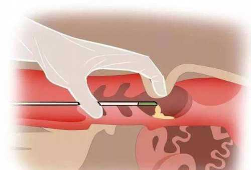 试管代怀套餐-Free-HCGβ偏高是什么意思